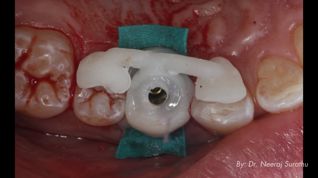 3D printed shell provisional with intraoral chairside pick up in patients mouth
