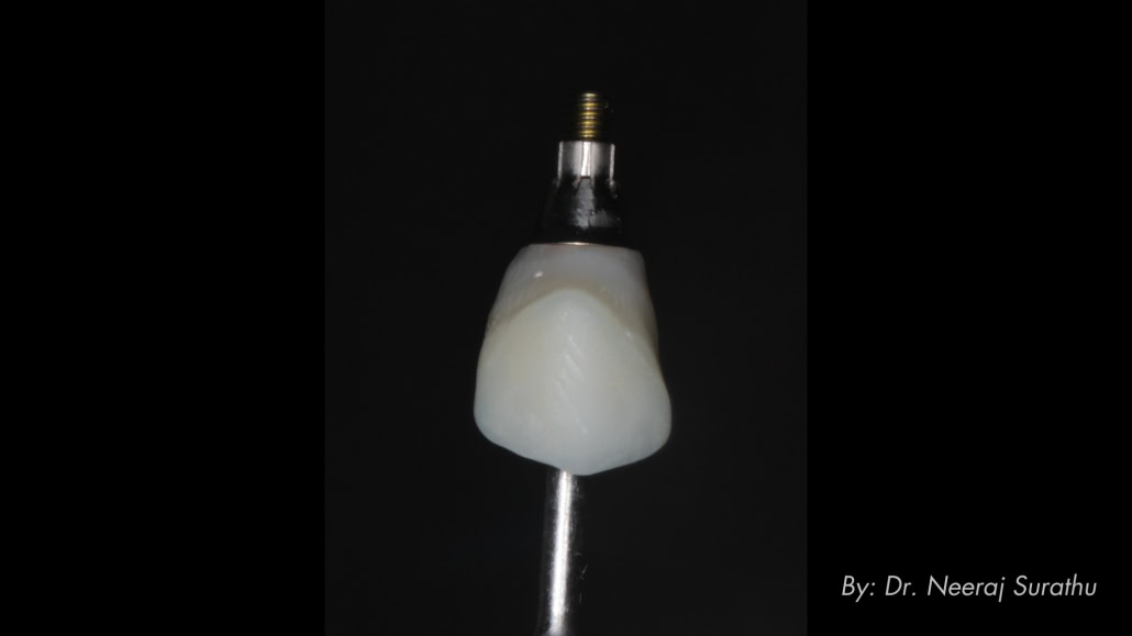 3D printed shell picked up using flowable composite and ready to deliver day of surgery