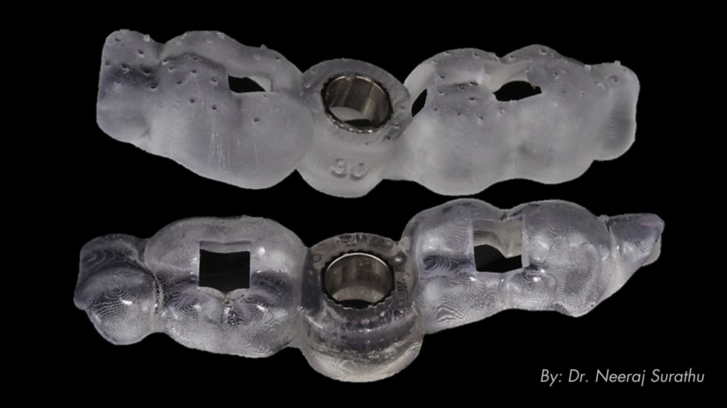 wo Surgical guides with fitted sleeve (Top: Straight from the 3D printer; Bottom: Post finish/post cure)
