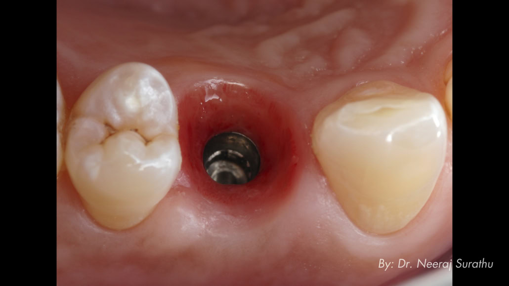 Picture that shows how well the soft tissue maturation is going for a patient after using an immediate provisional in #5 (First bicuspid/premolar) for 3 months