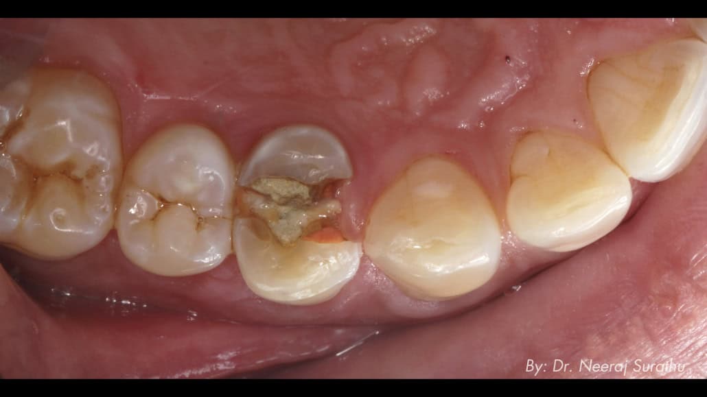 Image of a Fractured #5 (First bicuspid/premolar)