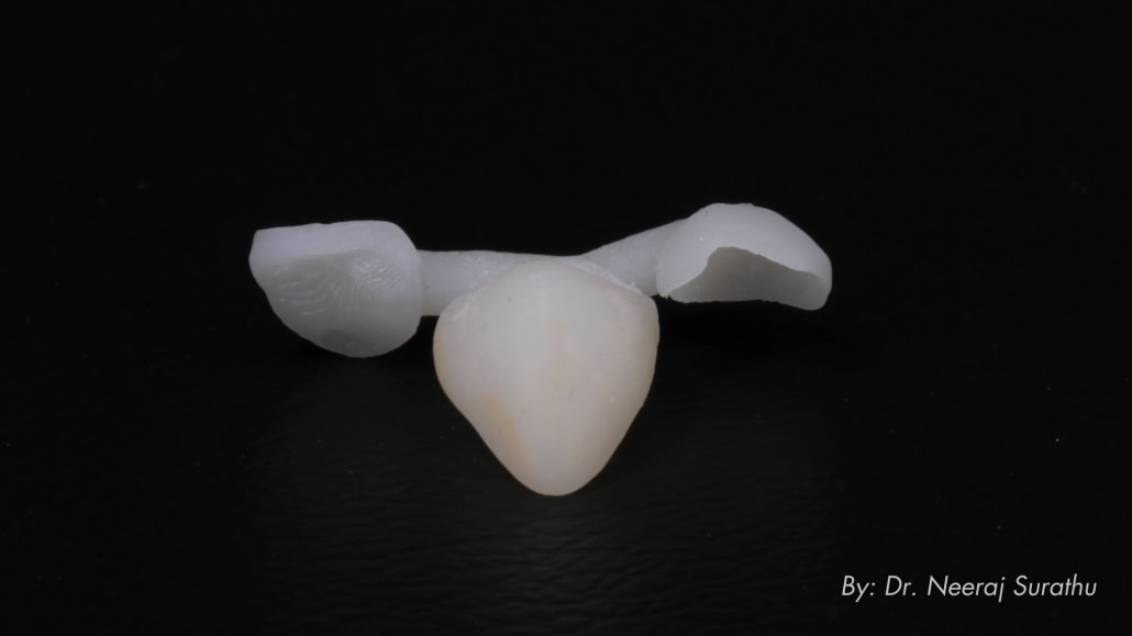 3D printed characterized shell provisional with vertical stop to guide intraoral chairside pick up